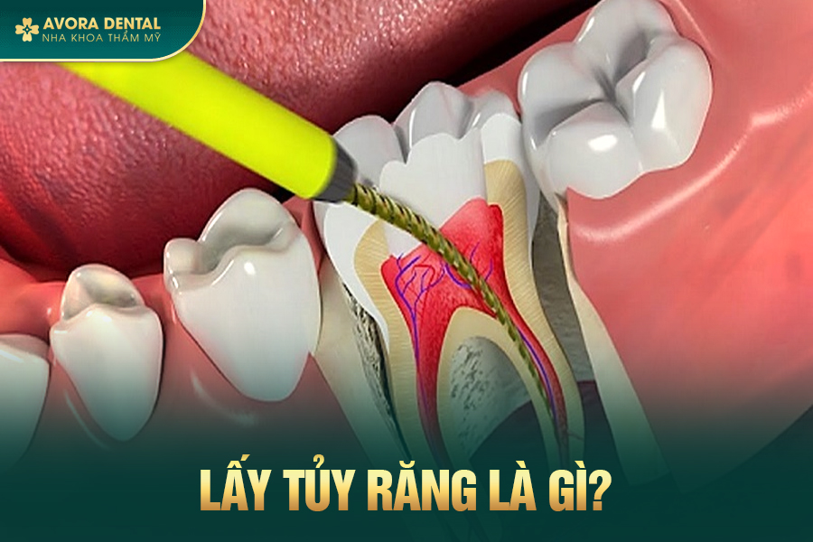 Bọc Răng Sứ Sau Khi Lấy Tủy Giá Bao Nhiêu? Bảng Giá Mới Nhất 2025