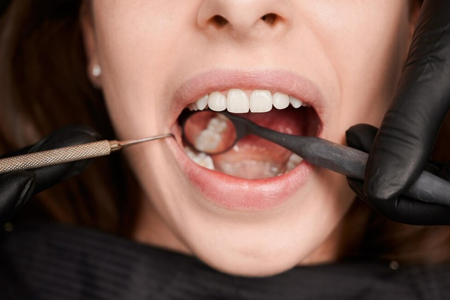 Cao răng gây ra những vấn đề gì? Làm sao để phòng ngừa?