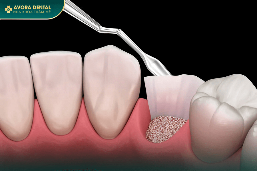 Ghép Xương Răng Trong Cấy Ghép Implant Là Gì? Chi Phí Bao Nhiêu 2025?
