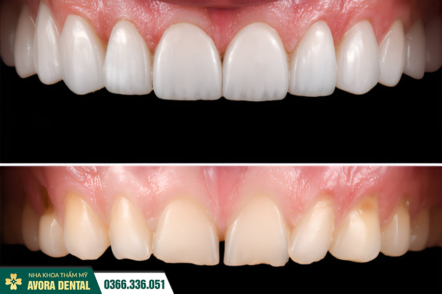 Nha khoa AVORA Dental – Địa chỉ Dán Răng Sứ Trả Góp Lãi Suất 0%