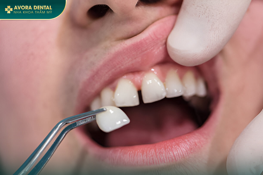 Top 5 Địa Chỉ Nha Khoa Dán Răng Sứ Uy Tín Ở TP.HCM