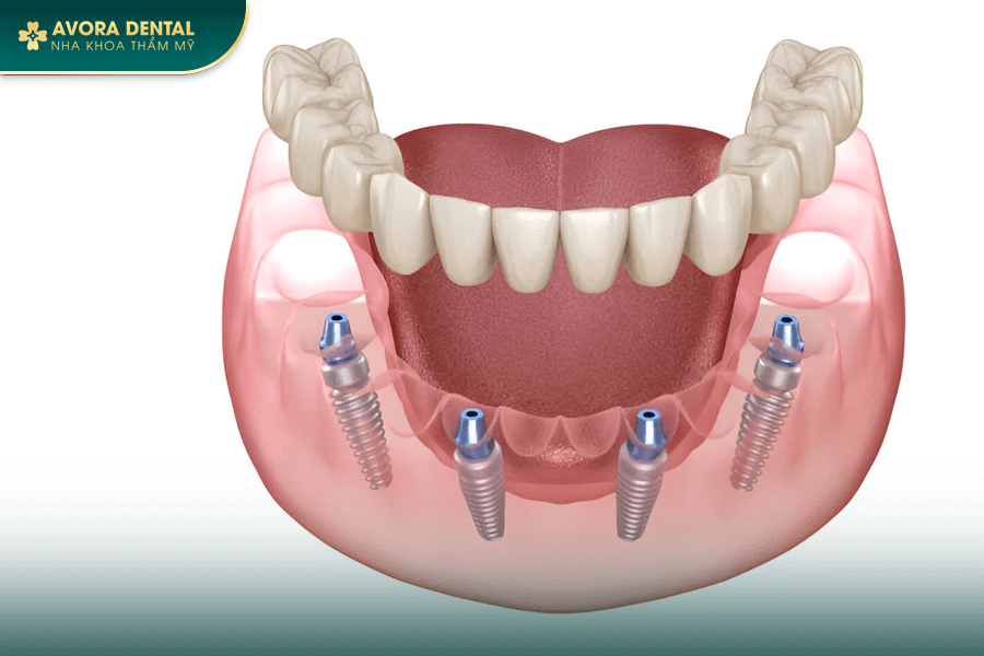 Trồng Răng Implant All On 4 Là Gì? Có Nên Thực Hiện Không? Giá Bao Nhiêu 2025?