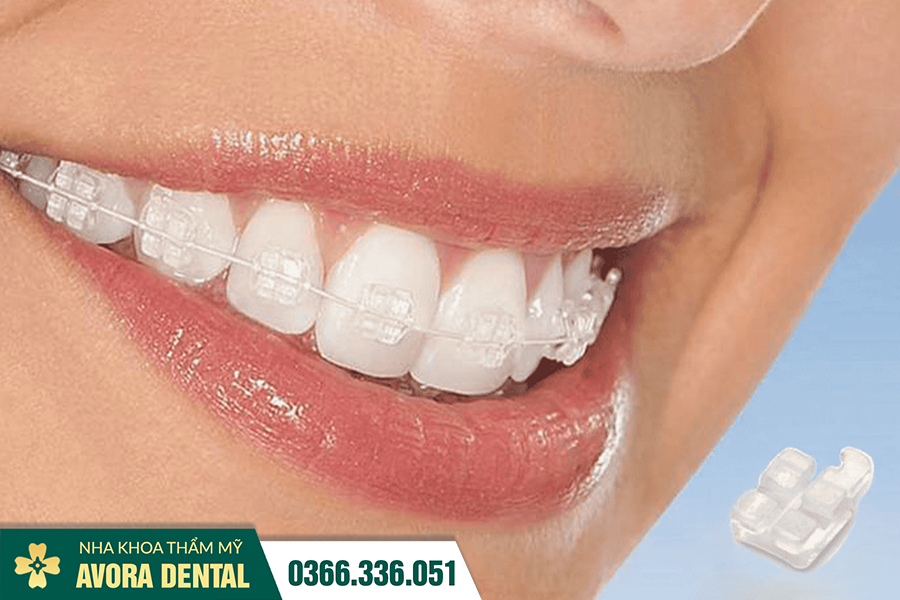 Niềng Răng Mắc Cài Pha Lê Là Gì? Phân Biệt Giữa Mắc Cài Sứ Và Mắc Cài Pha Lê?