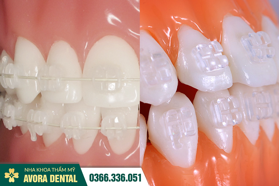 Niềng Răng Mắc Cài Trong Suốt Là Gì? Có Tốt Không? Chi Phí Bao Nhiêu?