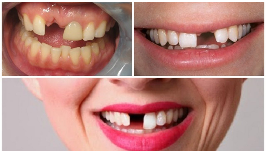Nên trồng răng loại nào thì phù hợp?