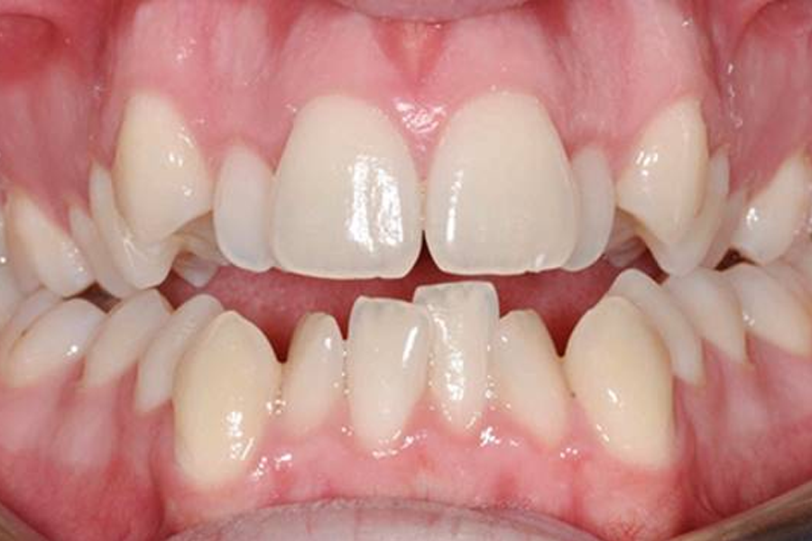 Những trường hợp lệch răng cần phải đến nha sĩ