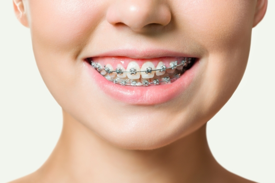 Niềng răng có làm răng bị yếu không?