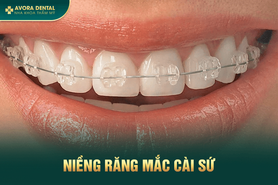 Niềng Răng Mắc Cài Sứ Là Gì? Có Tốt Không? Giá Bao Nhiêu 2025?