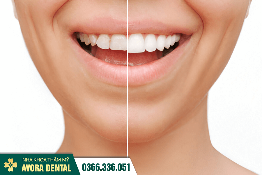 Bọc Răng Sứ Là Gì? Quy Trình Bọc Răng Sứ Gồm Những Bước Nào?