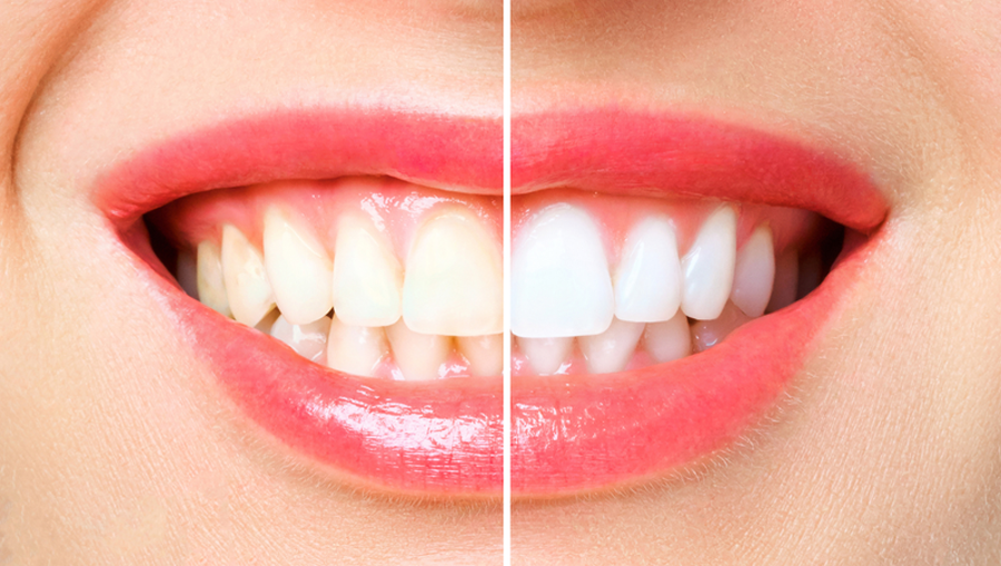 Quy trình tẩy trắng răng tại nha khoa - những điều bạn cần biết