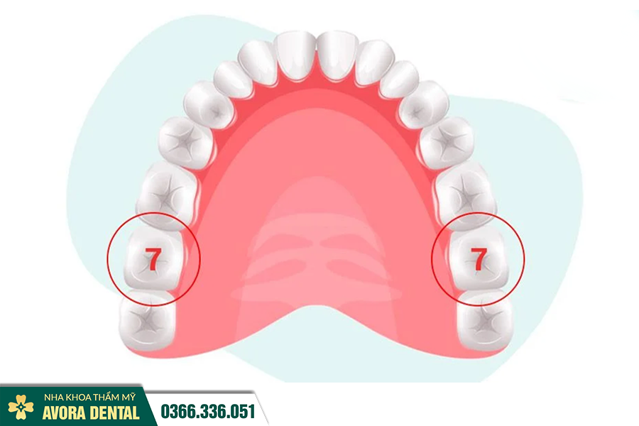 Trồng Răng Hàm Là Gì? Vì Sao Mất Răng Hàm Nên Trồng Càng Sớm Càng Tốt?
