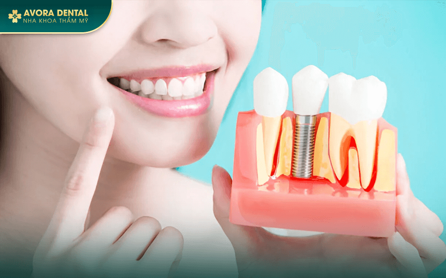 Trồng Răng Implant Trả Góp 0% Lãi Suất Tại Nha khoa AVORA Dental